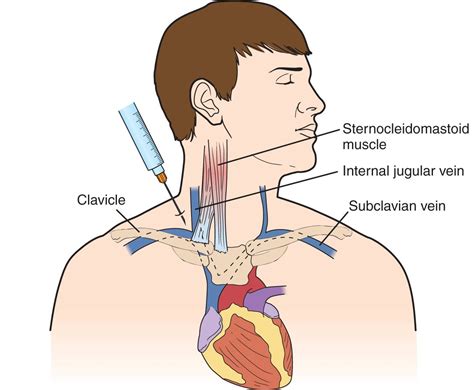 Subclavian Vein—Central Venous Access | Anesthesia Key