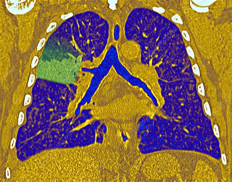 Pneumococcal pneumonia, CT scan - Stock Image - C029/4570 - Science Photo Library