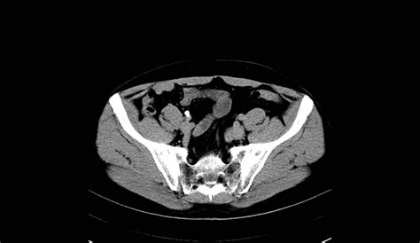 Abdomen Humanmanct Scan Trunk Examination Spine Photo Background And Picture For Free Download ...