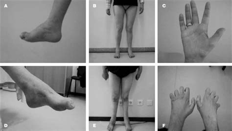 a, d: Pes cavus and hammertoes; b, e: inverse champagne bottle legs; c:... | Download Scientific ...