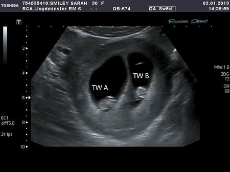 twin ultrasound pics | BabyCenter