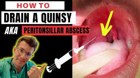 How to drain a QUINSY (aka peritonsillar abscess): A Step-by-step guide | Doctor O'Donovan ...