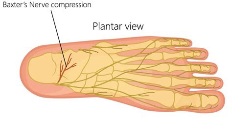 Plantar Nerve Entrapment