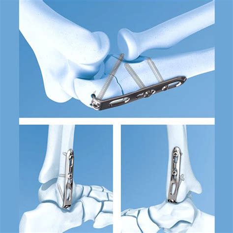 3.5mm LCP® Hook Plate – Welcome to SYS MEDTECH INTERNATIONAL PRIVATE LIMITED