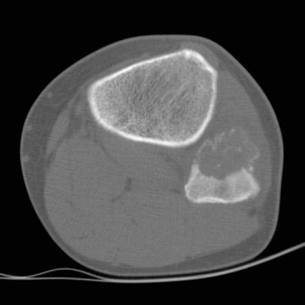 Lucent/lytic bone lesion - differential diagnosis (mnemonic) | Radiology Reference Article ...