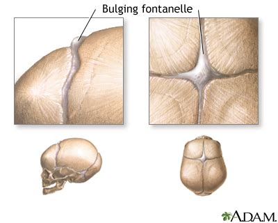 Bulging fontanelles: MedlinePlus Medical Encyclopedia Image