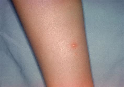 Chicken pox / Chickenpox (Hardin MD / CDC)