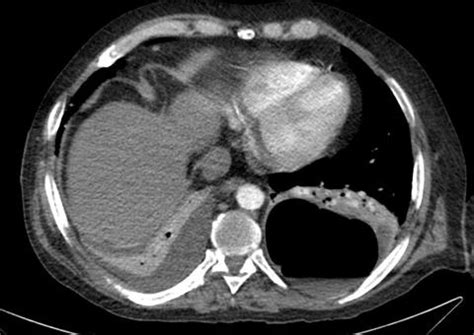 Southwest Journal of Pulmonary, Critical Care and Sleep - Imaging ...