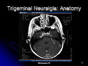 trigeminal neuralgia, houston, texas, tx, usa, west houston, memorial ...