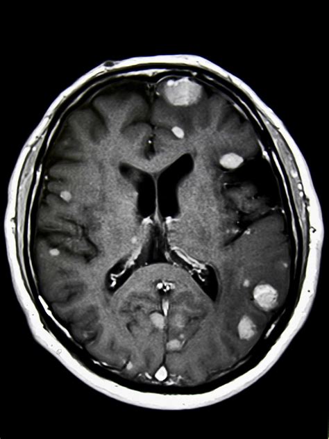 Breast Cancer and Metastasis to the Brain