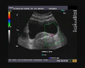 cochinblogs: Twinkle (color Doppler) artifacts in urinary calculi