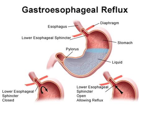 Gastroesophageal Reflux Disease (gerd) | Gastroenterology of Greater Orlando