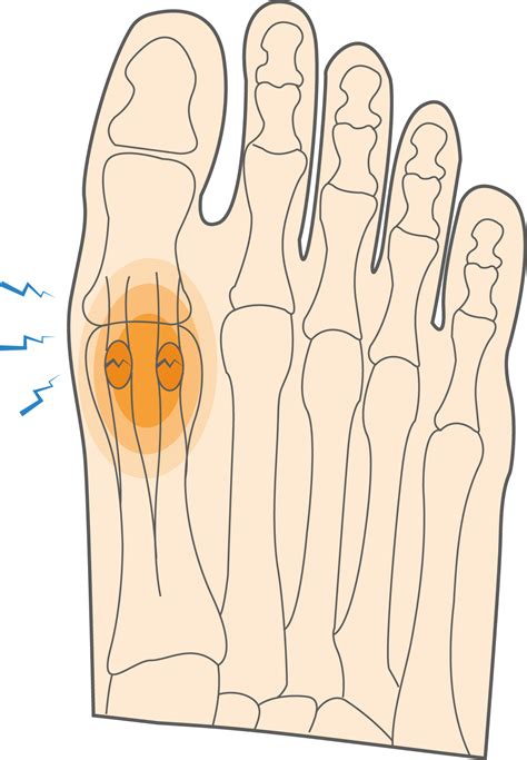 What is a Sesamoid Fracture & How to Manage Foot Injuries? - Upswing Health