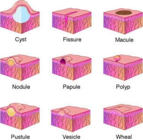 Types of skin eruptions and lesions | Nurse, Nursing school, Nursing school survival