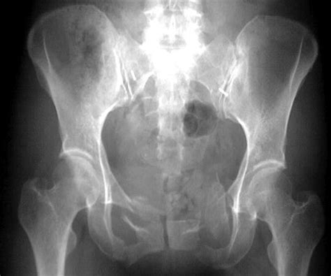 Pelvic Ring Fractures - Trauma - Orthobullets