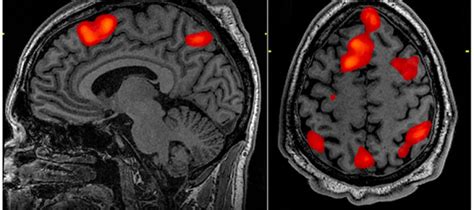 MRI Scan Detects Signs of Schizophrenia: Brain imaging test predicts ...