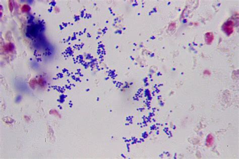 File:Purulent inflammation, Gram stain 3.jpg - Wikimedia Commons