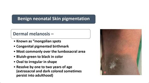 Mongolian Spots | Spot Diagnosis 29 | Pediatrics - YouTube