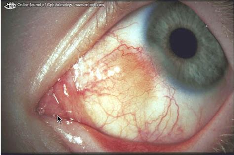 Renal Fellow Network: Scleritis and Kidney Disease - More than meets the eye...