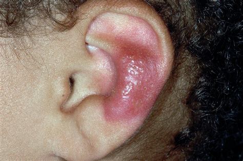 Herpes Simplex Lesion On The Ear Photograph by Dr P. Marazzi/science Photo Library