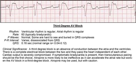 Av Heart Block Types
