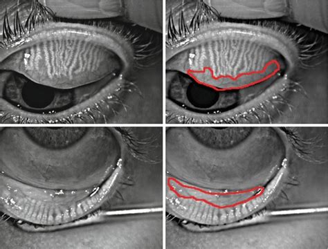 Update in the Diagnosis and Management of Meibomian Gland Dysfunction | Ento Key