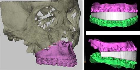 RBCP - The use of virtual planning in orthognathic surgery
