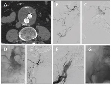 Type II Endoleak Embolization: The Methods Behind the Access ...