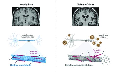 The pathological properties of the Alzheimer's disease brain (involving ...