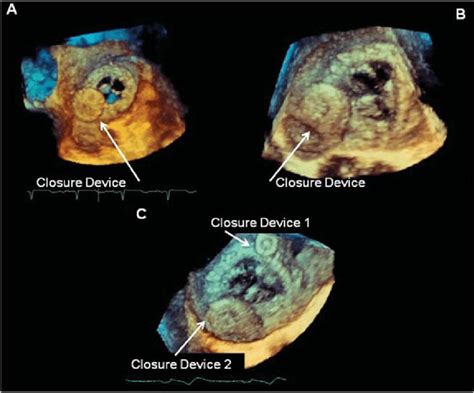 Amplatzer closure device in place. | Download Scientific Diagram