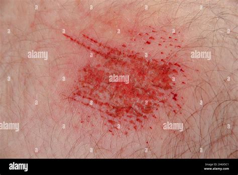 Close up of an abrasion wound in Caucasian skin Stock Photo - Alamy