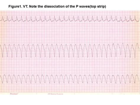 Ventricular Arrhythmia - The Cardiology Advisor