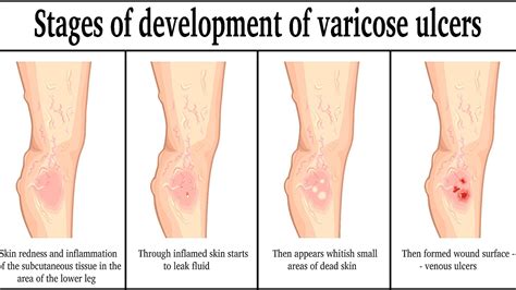 Venous Stasis Leg Ulcer - Ulcer Choices