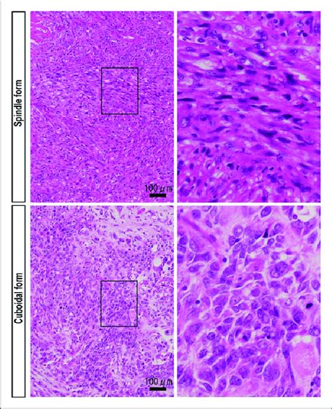 Histology of epithelial carcinoma sarcomatous components. Hematoxylin ...