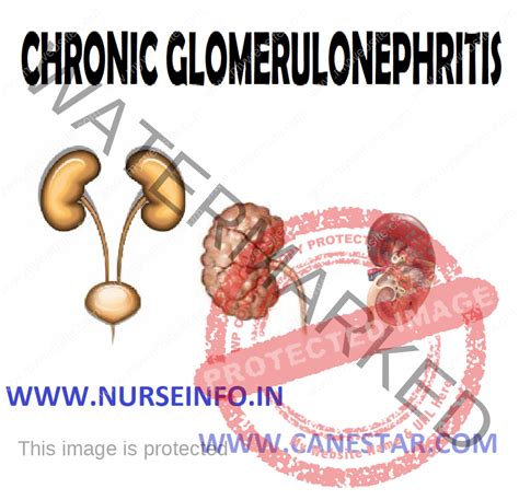 CHRONIC GLOMERULONEPHRITIS - Nurse Info