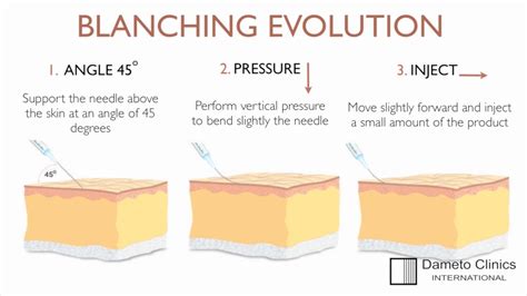 Dr. Gabriel Siquier "blanching evolution" technique at Dameto Clinics International - YouTube