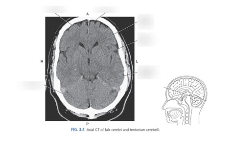 Axial CT of Falx Cerebri & Tentorium Cerebelli Diagram | Quizlet