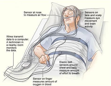 About The "Sleep Test (Polysomnography - PSG)"