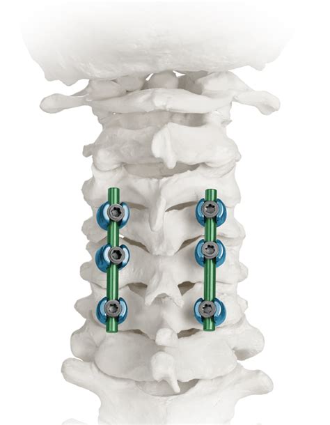 Posterior Cervical Fusion Procedure | Globus Medical