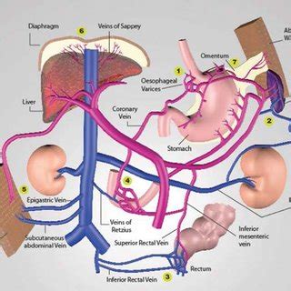 Different sites of portosystemic anastomosis which can form varices. 1 ...