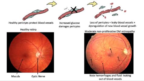 Diabetic Eye Exam - SeeRite Eye Clinic - North York Toronto