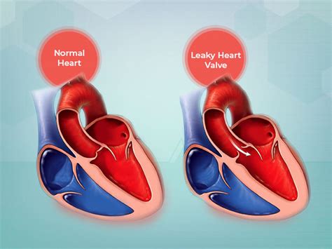 What Is Leaky Heart Valve? Its Symptoms, Causes And Treatment - Boldsky.com