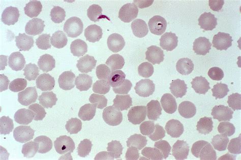 Plasmodium Falciparum Blood Smear