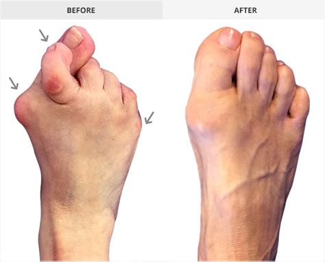 Finding the Best Bunion Surgeon: What You Need to Know