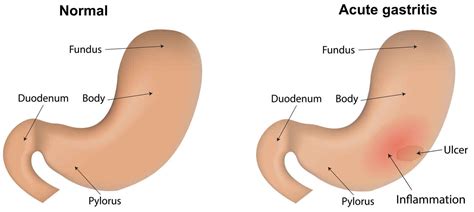 Acute gastritis causes, symptoms, diagnosis, treatment & prognosis