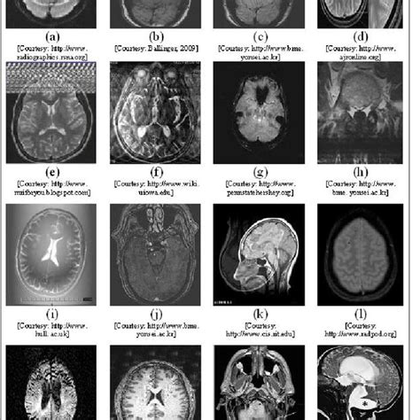 Different types of artifacts in brain MRI (a) Chemical Shift (b ...