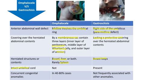 Omphalocele v/s Gastroschisis || Spot Diagnosis - 6 || Pediatrics - YouTube