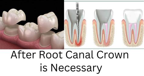 Why A Crown After Root Canal Treatment is a Must?