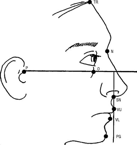 Sliding Genioplasty for Correction of Chin Abnormalities | Facial Plastic Surgery | JAMA Facial ...