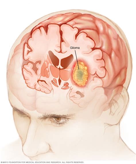 Glioma - Síntomas y causas - Mayo Clinic